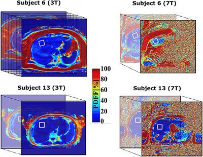 Feasibility of Hepatic Fat Quantification Using Proton Density Fat Fraction by Multi-Echo Chemical-Shift-Encoded MRI at 7T